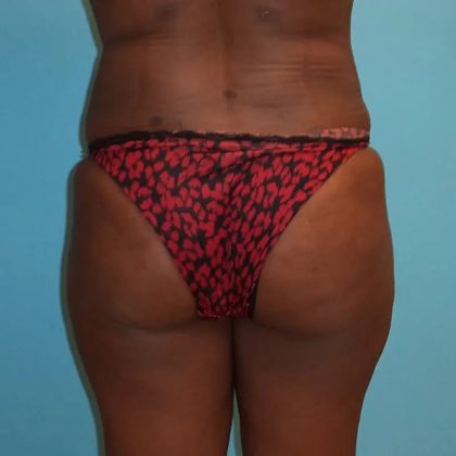 Brazilian Butt Lift Before & After Patient #182