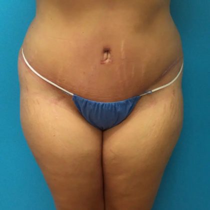 Tummy Tuck Before & After Patient #90