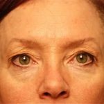 Blepharoplasty Before & After Patient #138