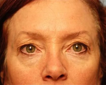 Blepharoplasty Before & After Patient #138
