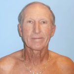 Facelift Before & After Patient #416