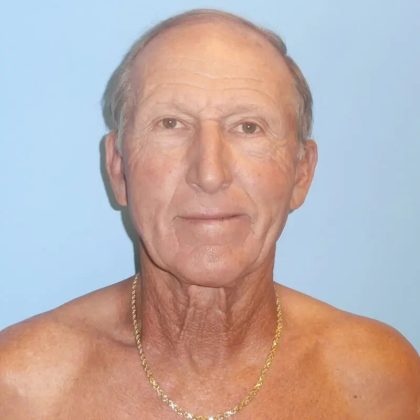 Facelift Before & After Patient #416