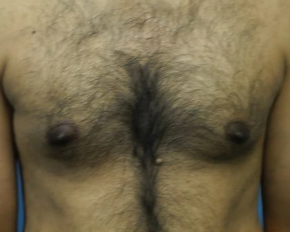 Gynecomastia Before & After Patient #453