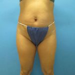 Liposuction Before & After Patient #491