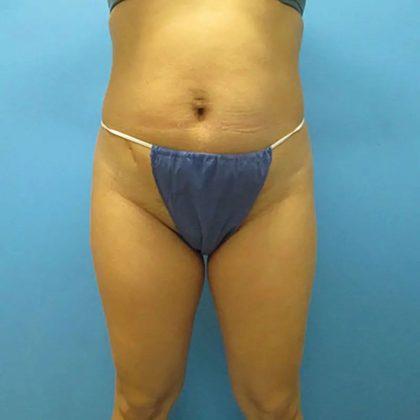 Liposuction Before & After Patient #491