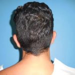 Otoplasty Ear Pinning Before & After Patient #609