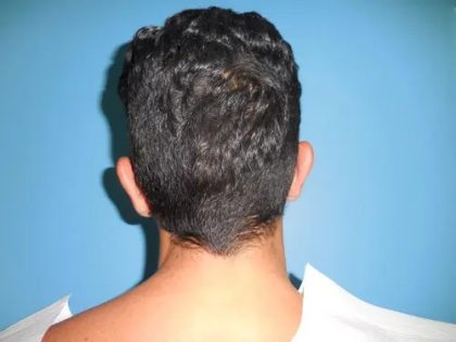 Otoplasty Ear Pinning Before & After Patient #609