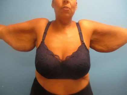 Arm Lift Before & After Patient #158