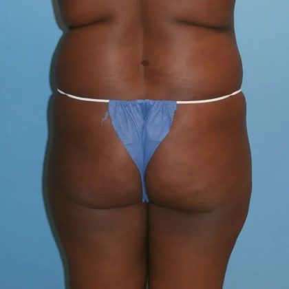 Brazilian Butt Lift Before & After Patient #182