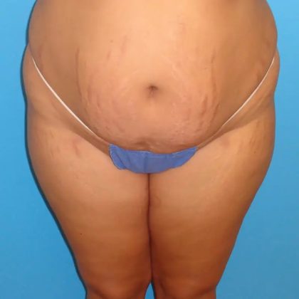 Tummy Tuck Before & After Patient #90