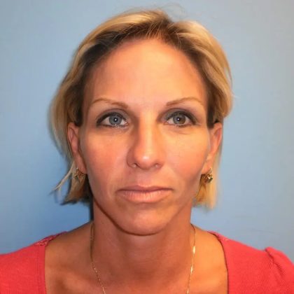 Brow Lift Before & After Patient #324