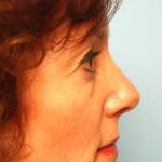Blepharoplasty Before & After Patient #138
