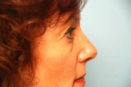Blepharoplasty Before & After Patient #138