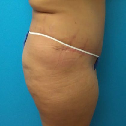 Tummy Tuck Before & After Patient #90