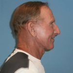 Facelift Before & After Patient #416