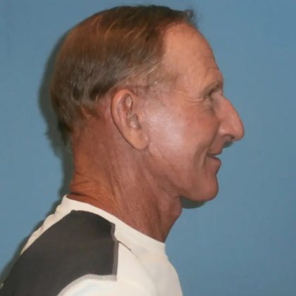 Facelift Before & After Patient #416