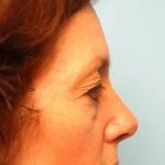 Blepharoplasty Before & After Patient #138