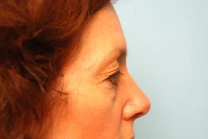 Blepharoplasty Before & After Patient #138