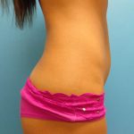 Coolsculpting Before & After Patient #344