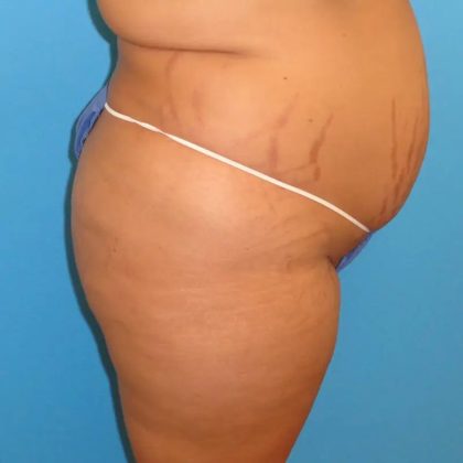 Tummy Tuck Before & After Patient #90