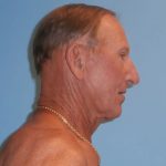 Facelift Before & After Patient #416