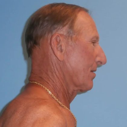 Facelift Before & After Patient #416