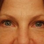 Blepharoplasty Before & After Patient #143