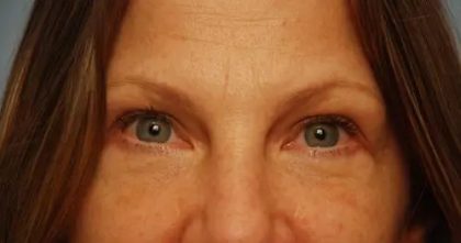 Blepharoplasty Before & After Patient #143