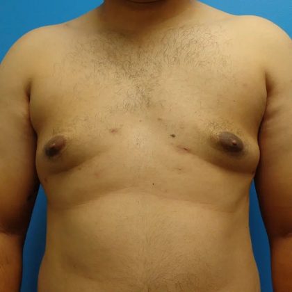 Gynecomastia Before & After Patient #458