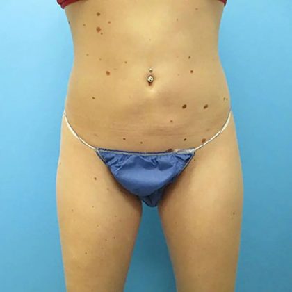 Liposuction Before & After Patient #496