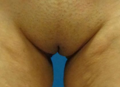 Labiaplasty Before & After Patient #648