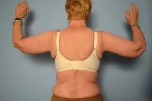 Arm Lift Before & After Patient #161