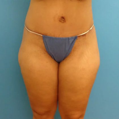 Tummy Tuck Before & After Patient #95