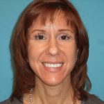 Facelift Before & After Patient #421
