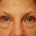 Blepharoplasty Before & After Patient #143