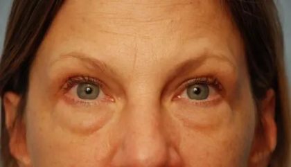 Blepharoplasty Before & After Patient #143