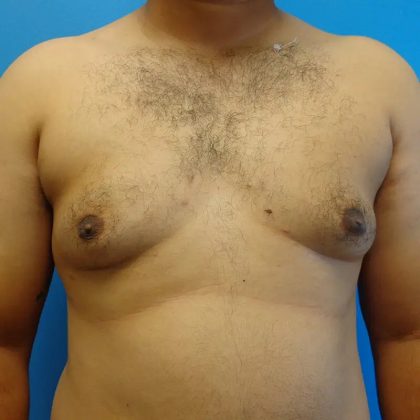 Gynecomastia Before & After Patient #458