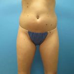 Liposuction Before & After Patient #496