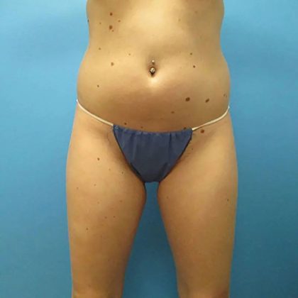 Liposuction Before & After Patient #496
