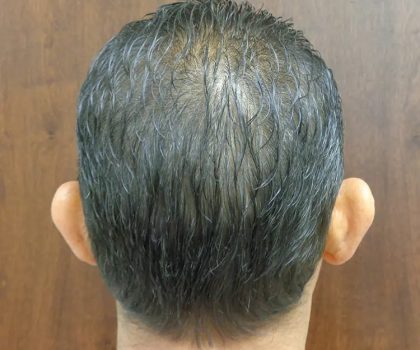 Otoplasty Ear Pinning Before & After Patient #614