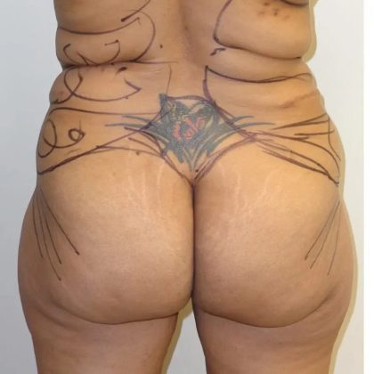 Brazilian Butt Lift Before & After Patient #187