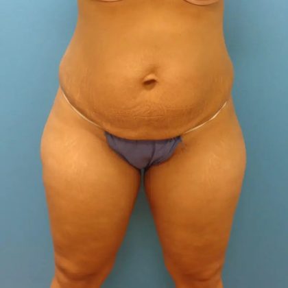 Tummy Tuck Before & After Patient #95