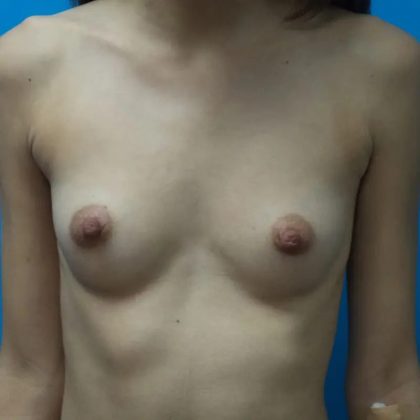 Breast Augmentation Before & After Patient #261