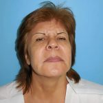 Brow Lift Before & After Patient #331