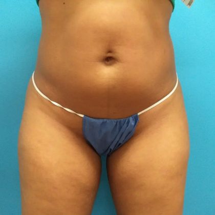 Coolsculpting Before & After Patient #351