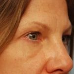 Blepharoplasty Before & After Patient #143