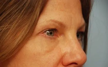 Blepharoplasty Before & After Patient #143