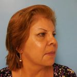 Brow Lift Before & After Patient #331