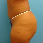 Coolsculpting Before & After Patient #351