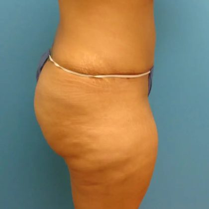 Tummy Tuck Before & After Patient #95